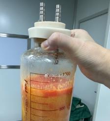 三明水动力吸脂手术要做多久？